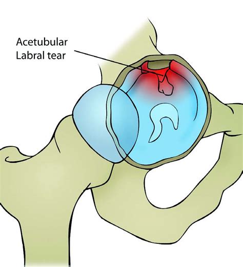 acetabular labrum hip pain